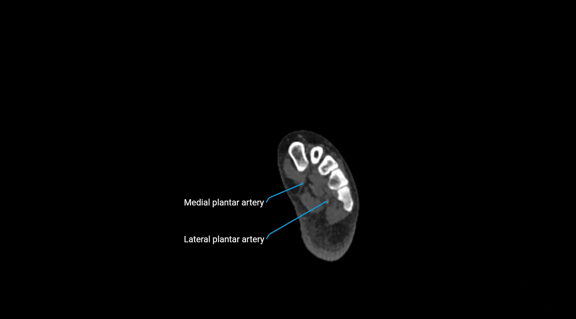 CTA lower limb cross sectional anatomy labelled image _294.webp